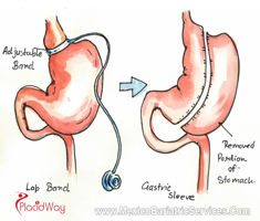 Slider image (4) Dr. Hector Perez Corzo Bariatric Surgery Mexico